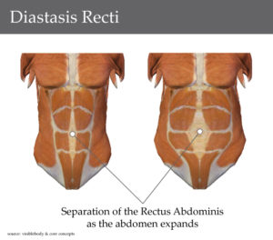 Mums & Abdominal Separation - ProPhysio+