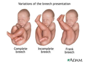 breech positions