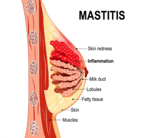 Mastitis images