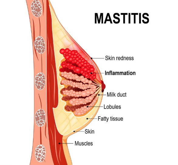 Mastitis and The Rule of 5