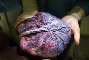 Placenta on providers gloved hands