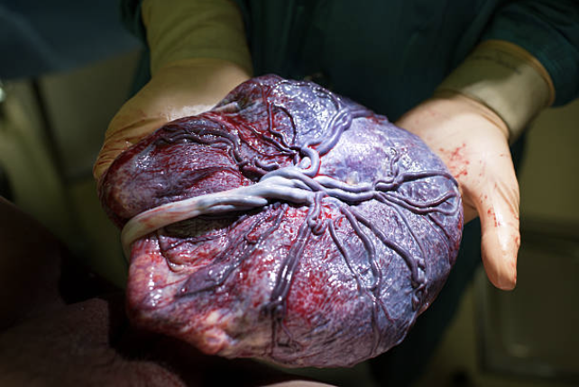 Placenta on providers gloved hands
