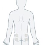 Human outline showing TENS placement on abdomen