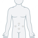 Human outline showing TENS placement on abdomen