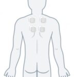 Human outline showing TENS placement on upper back and shoulder