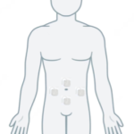 Image of tens placement on abdomen
