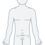 Human outline showing TENS placement on abdomen